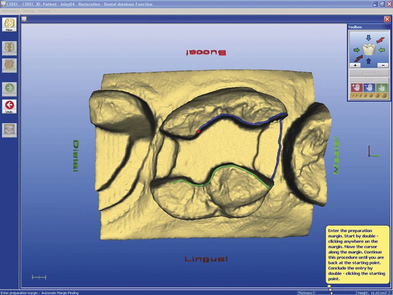 Cerec - Dreidimensionales Zahn-Abbild