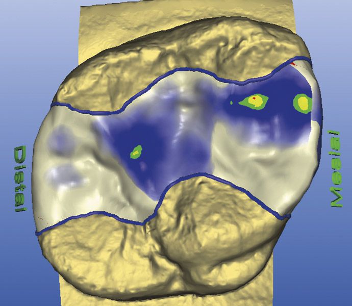 Cerec - Digitale Konstruktion